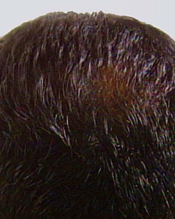 Men's Hair Restoration