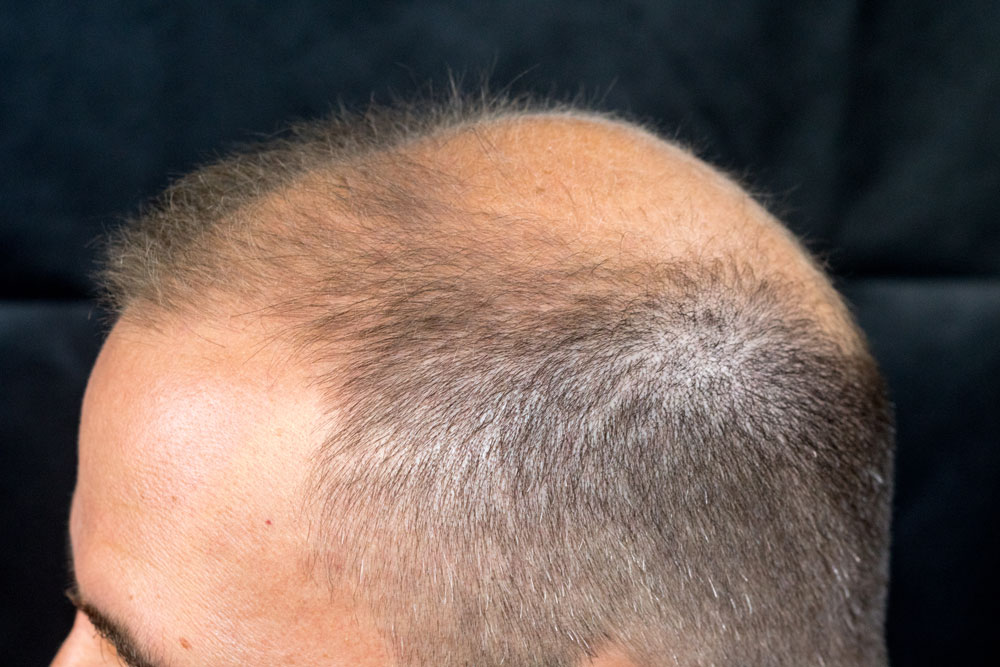 Mens Hair Loss Treatment